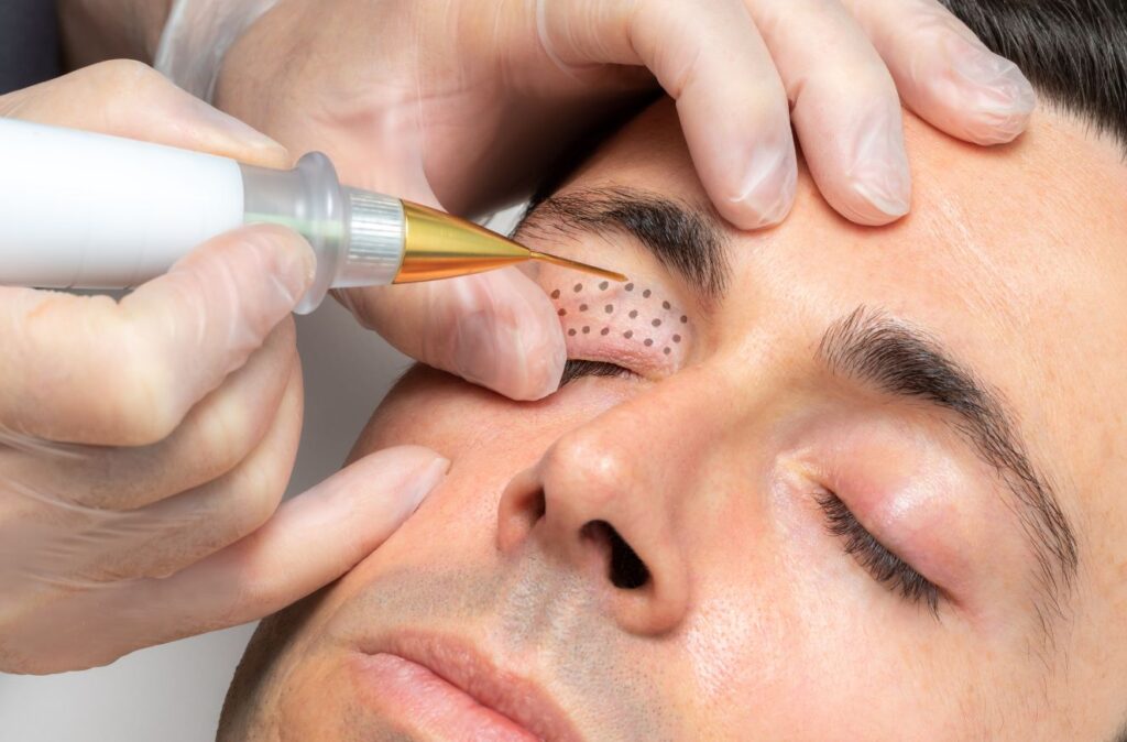 Die Plasma-Pen-Behandlung Minimal-invasive Verfahren