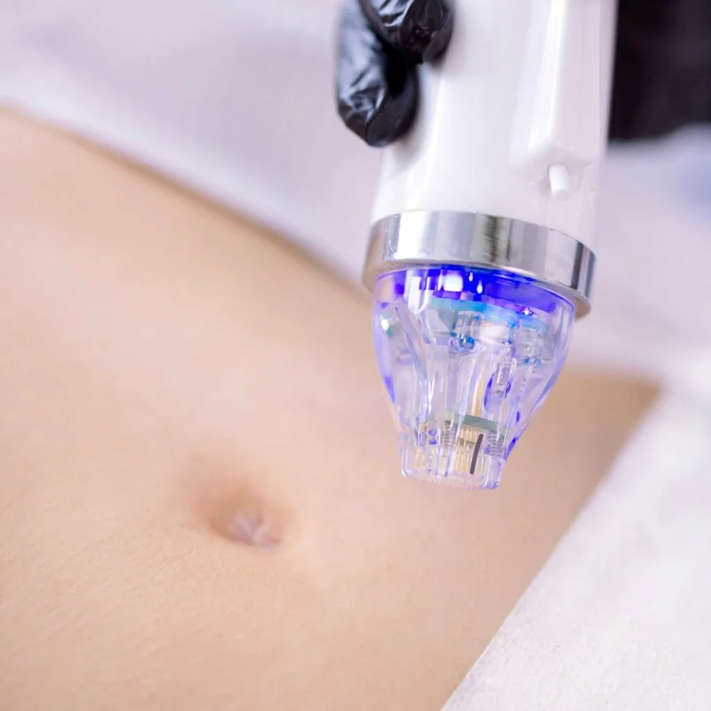 radiofrequenz und microneedling minimal-invasive verfahren