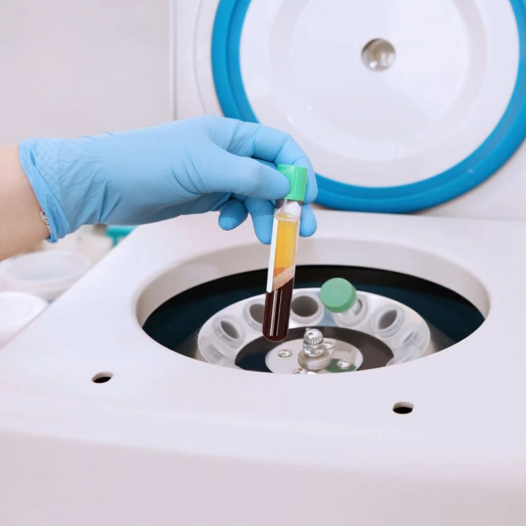 PRP Plasmabehandlung Minimal-invasive Verfahren