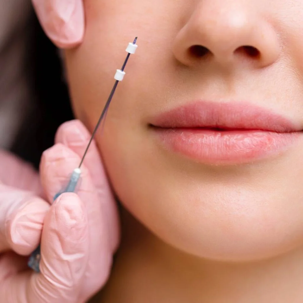 Fadenlifting Minimal-invasive Verfahren