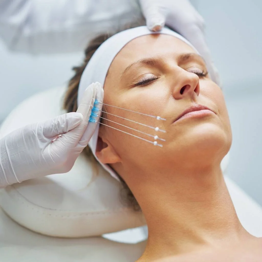 Fadenlifting Minimal-invasive Verfahren